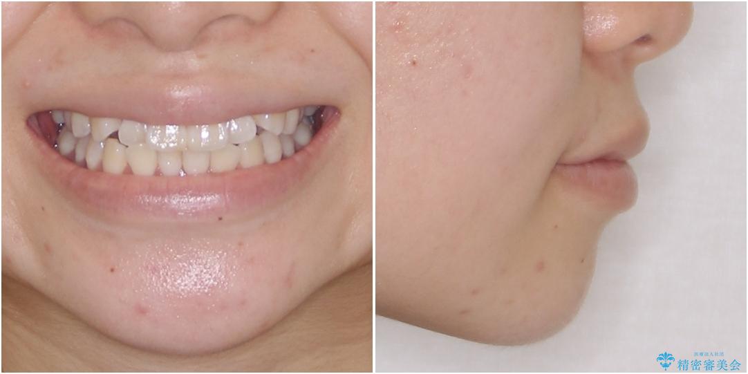 海外留学をしながら歯並びを整えたい インビザラインによる矯正治療の治療前(顔貌)