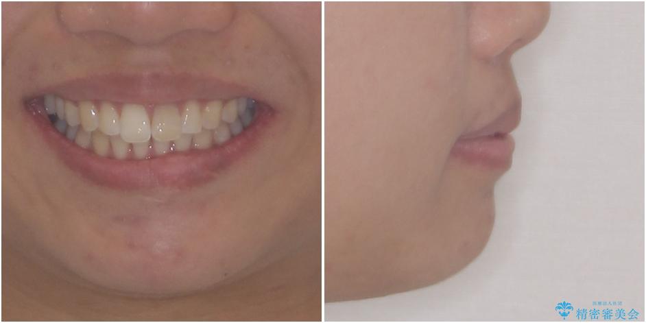気になる前歯を治したい　インビザライン矯正とオールセラミッククラウンの治療前（顔貌）