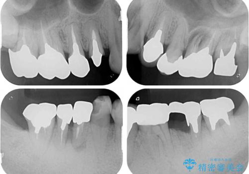 折れてしまった奥歯 インプラントによる補綴治療の治療前