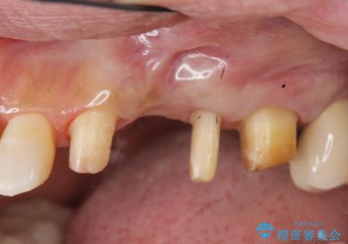 歯周病 側方力に対抗するブリッジ補綴の治療中