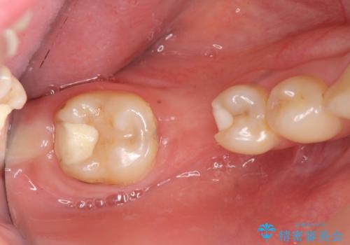 臼歯インプラント補綴の治療前