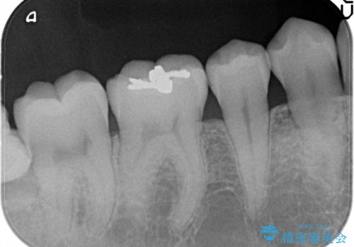 メタルフリーの治療 セラミックインレー の治療前
