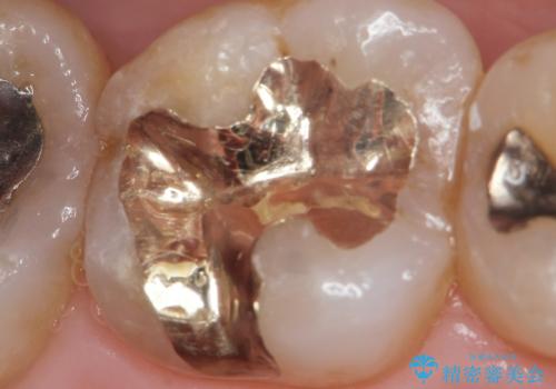 銀歯の引っかかり　化学的に安定したゴールドインレー修復の治療後