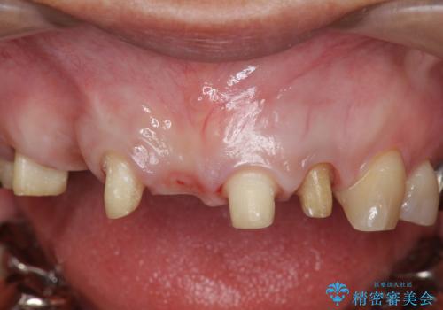 過度な咬合力 歯ぎしりで抜けた歯の欠損補綴の治療中