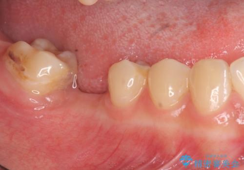 臼歯インプラント補綴の治療前