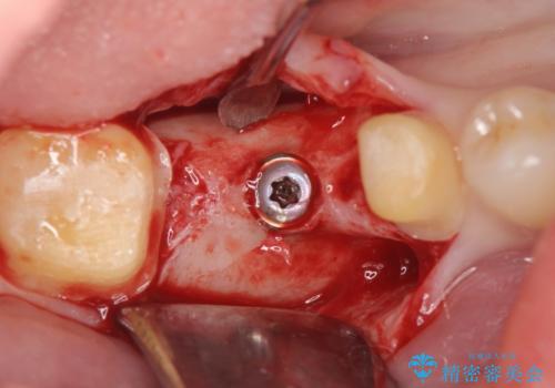 臼歯インプラント補綴の治療中