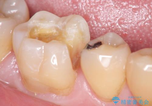 歯の神経を残す、丁寧な虫歯の除去の治療中