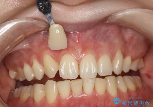 できるだけ白くしたい!エクセレントホワイトニングの治療前