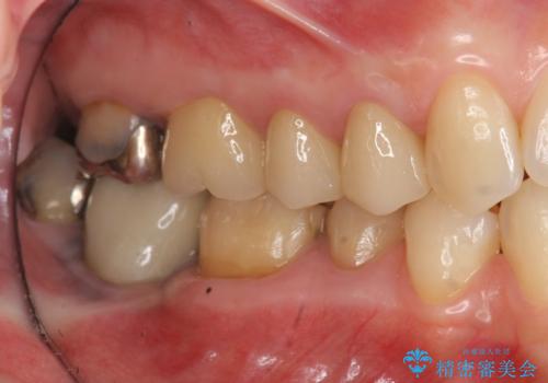 精度の高いセラミッククラウンの治療後