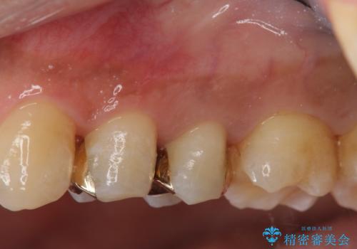 近所で入れた銀歯に食べ物が挟まるの症例 治療後