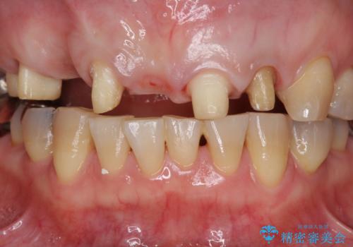 過度な咬合力 歯ぎしりで抜けた歯の欠損補綴の治療中