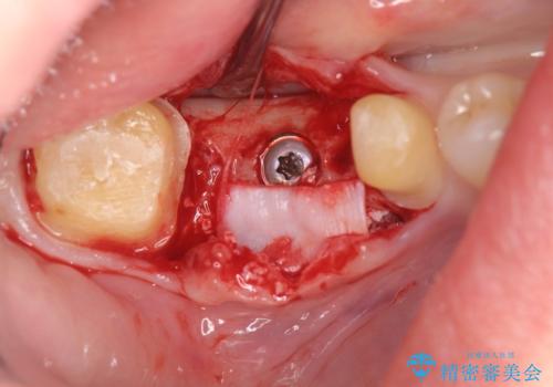 臼歯インプラント補綴の治療中