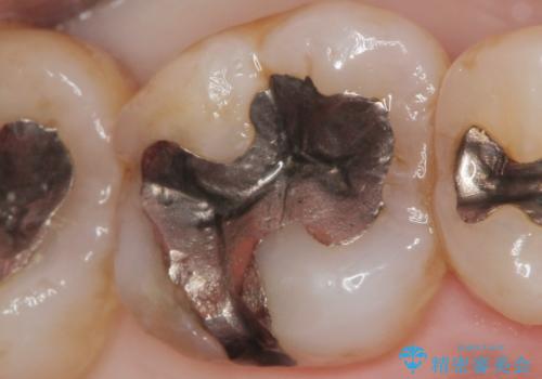 銀歯の引っかかり 化学的に安定したゴールドインレー修復の治療前