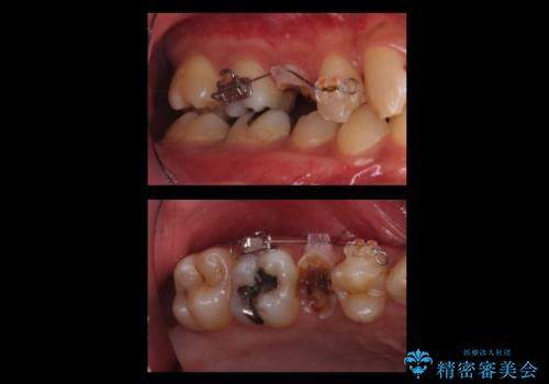放置した虫歯　歯ぐきの中まで虫歯でも、しっかり健康的な部分を引っ張り出して、きちんと処置します。の治療中