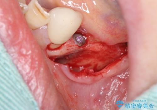 入れ歯で食事が楽しくなくなった。インプラントでまたしっかりとかみたいの治療前