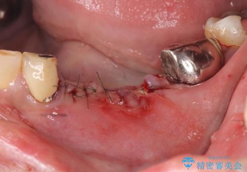 [歯の破折] インプラント埋入を行うための大規模骨造成の治療前
