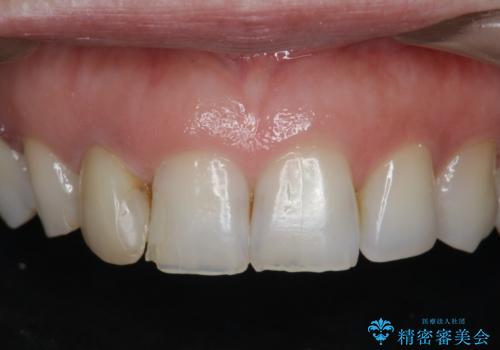 前歯の違和感　失活歯の根管治療とセラミック治療の治療前