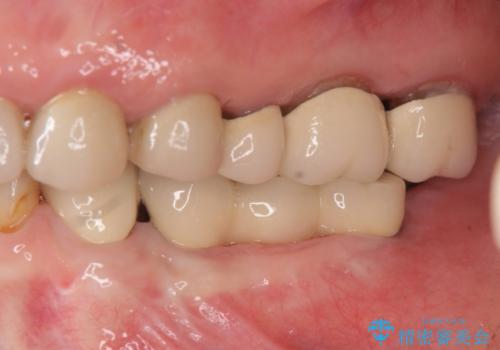 入れ歯で食事が楽しくなくなった。インプラントでまたしっかりとかみたいの治療後