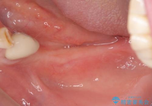 入れ歯で食事が楽しくなくなった。インプラントでまたしっかりとかみたいの治療中