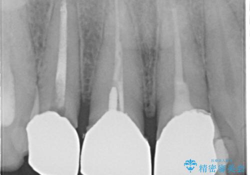 昔装着したかぶせ物を自然な色にしたい オールセラミックによる審美的改善の治療前