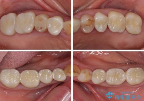 全ての奥歯の銀歯をセラミックに　メタルフリー治療の治療後