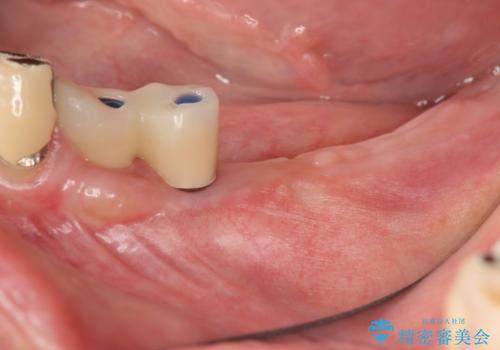 [歯の破折] インプラント埋入を行うための大規模骨造成の治療中
