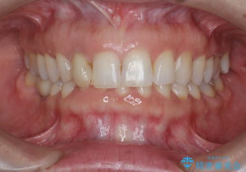 前歯の違和感　失活歯の根管治療とセラミック治療の治療前