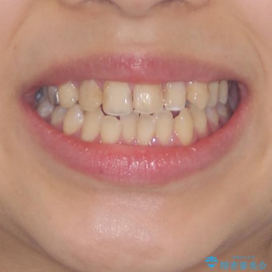 後戻りを治したい 骨格的なズレの大きい方のインビザライン矯正の治療前(顔貌)