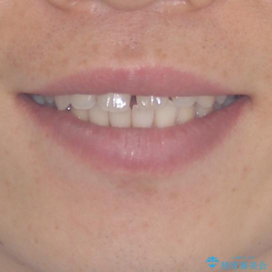 すきっ歯の改善　インビザライン矯正治療の治療前（顔貌）
