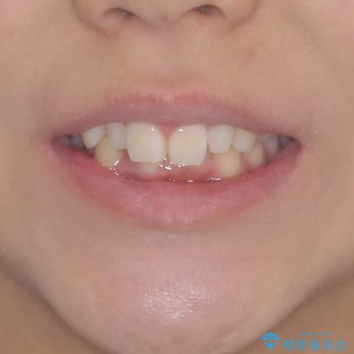 前歯のデコボコを治したい　インビザラインによる矯正治療の治療前（顔貌）