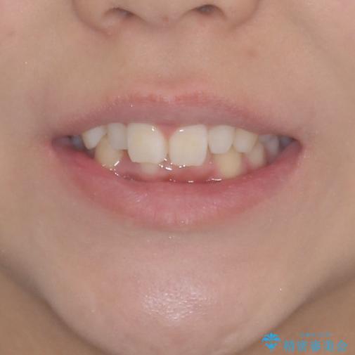 前歯のデコボコを治したい インビザラインによる矯正治療の治療前(顔貌)