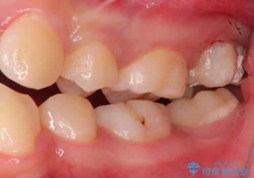 奥歯が痛い。ラバーダム使った治療がしたい。の治療前