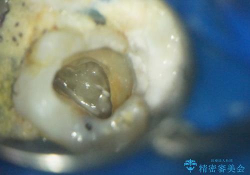 奥歯が痛い。ラバーダム使った治療がしたい。の治療中