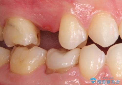 隙間が気になる。審美性の高いインプラント治療の治療前