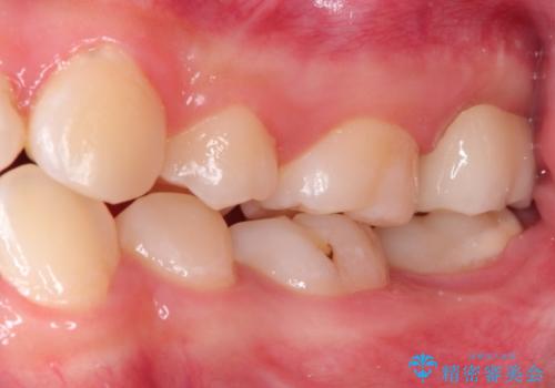 奥歯が痛い。ラバーダム使った治療がしたい。の治療後