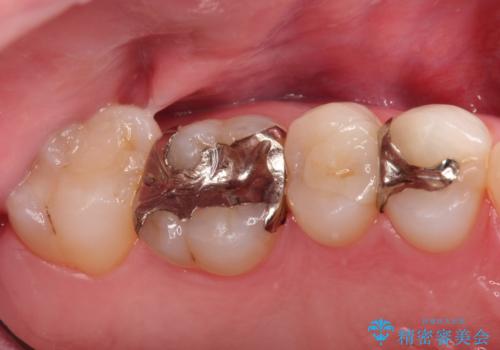 見た目が綺麗なセラミックインレーの治療前