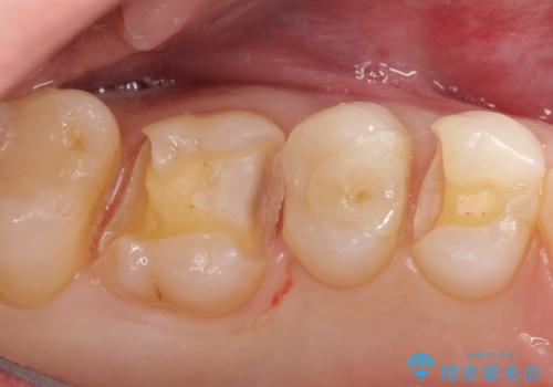 見た目が綺麗なセラミックインレーの治療中