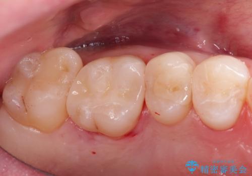 見た目が綺麗なセラミックインレー