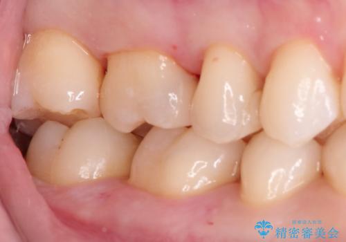 見た目が綺麗なセラミックインレーの治療後