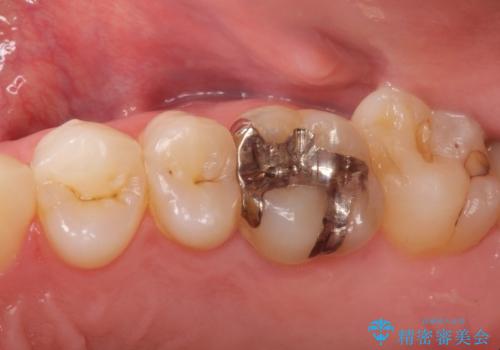 メタルフリー セラミックインレーの治療前