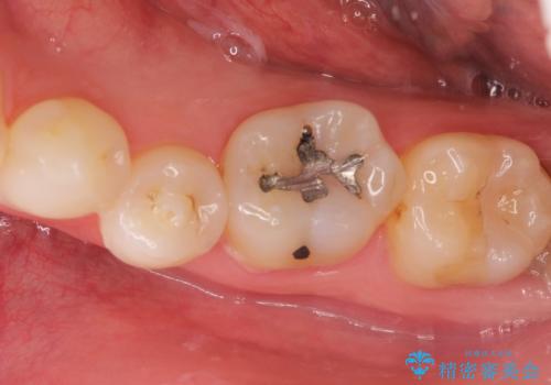 メタルフリー セラミックインレーの治療前