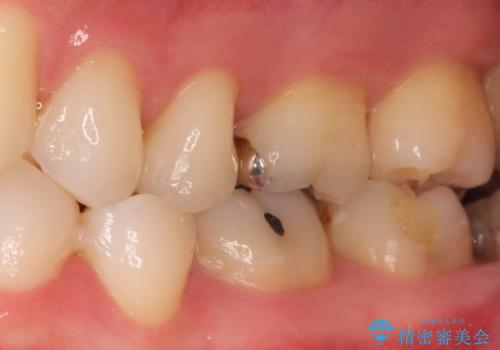 メタルフリー セラミックインレーの症例 治療前