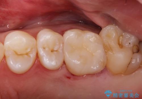メタルフリー セラミックインレーの治療後