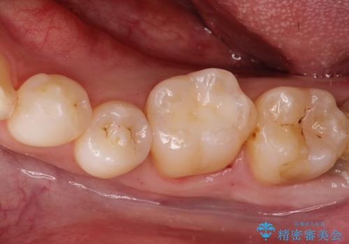 メタルフリー セラミックインレーの治療後