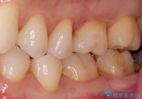メタルフリー セラミックインレーの症例 治療後