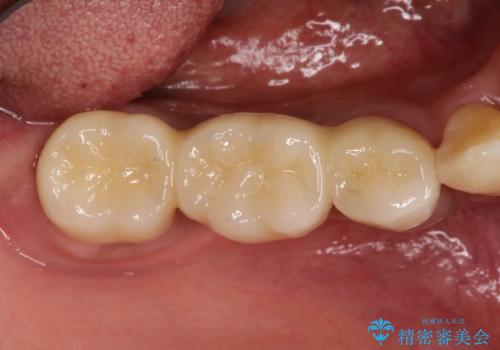 奥歯が痛い。ブリッジによる欠損補綴の治療後