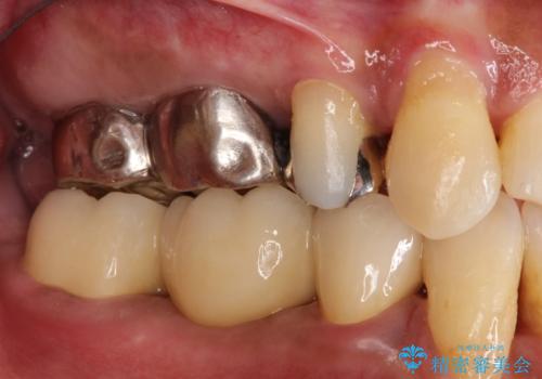 奥歯が痛い。ブリッジによる欠損補綴の治療後