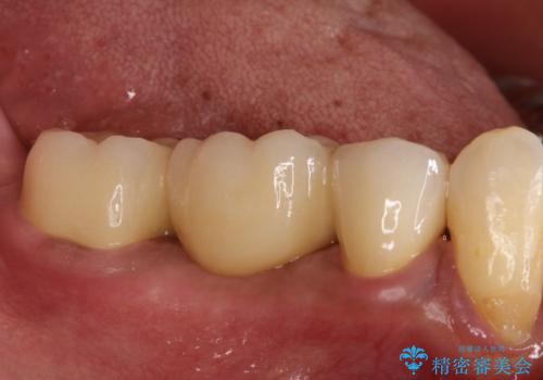 奥歯が痛い。ブリッジによる欠損補綴の治療後