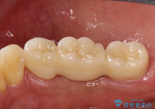 奥歯が痛い。ブリッジによる欠損補綴の治療後