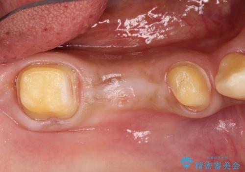 奥歯が痛い。ブリッジによる欠損補綴の治療中